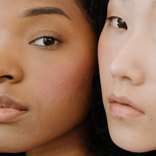 What is juvenile acne and how to fight it?