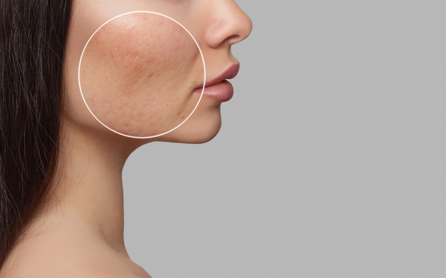 How can acne scars be treated?