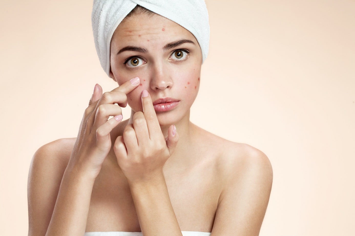 Everything you need to know about acne in adulthood