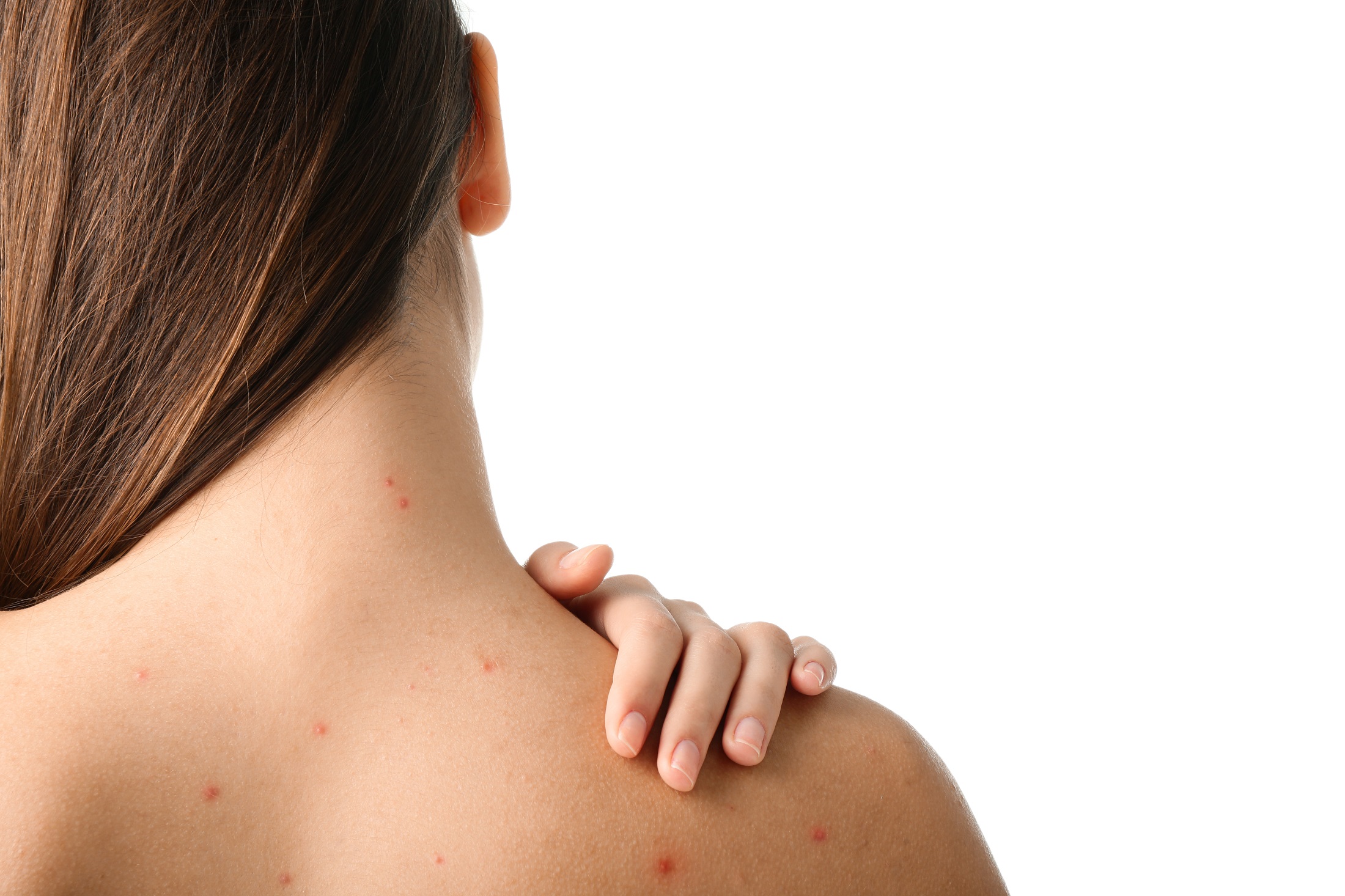 Acne on the back – why does it appear and how can you get rid of it?