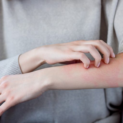 Psoriasis is a disease that is no longer a taboo subject. Learn about its causes, symptoms and treatment