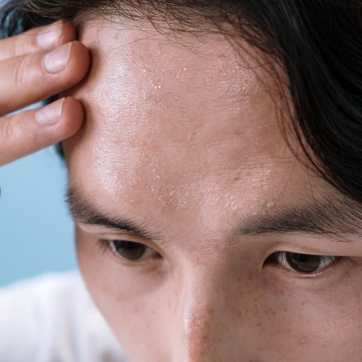 Acne of the scalp – why does it appear and how to get rid of it effectively?
