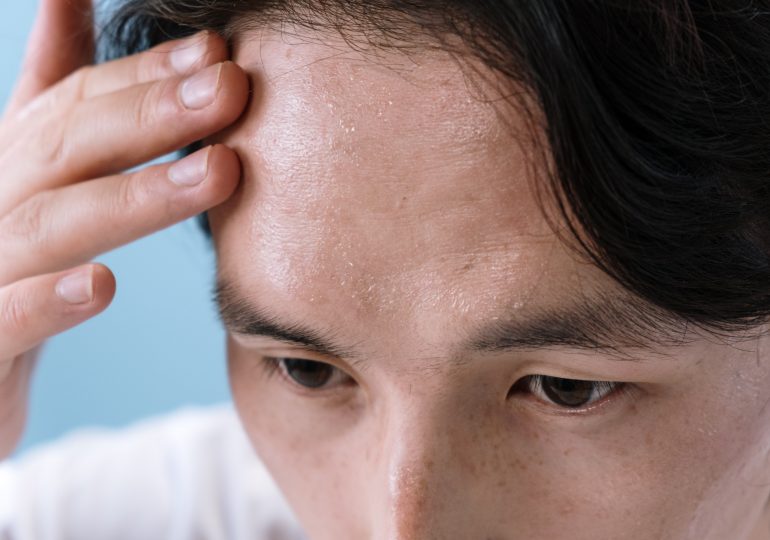 Acne of the scalp - why does it appear and how to get rid of it effectively?