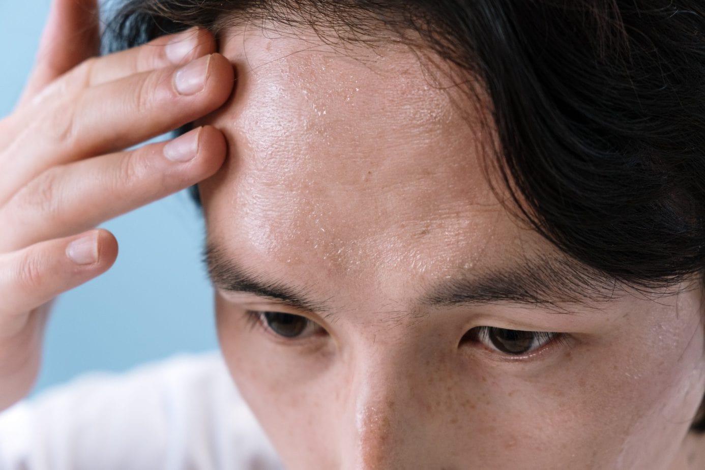 Acne of the scalp – why does it appear and how to get rid of it effectively?